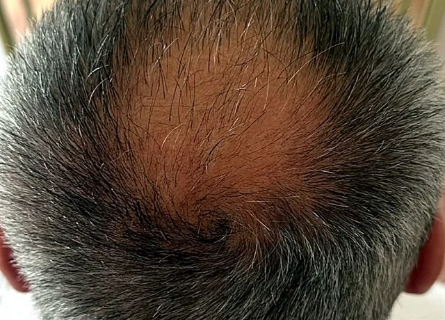Kopfhaut nach der Cold Plasma Scalp Therapy